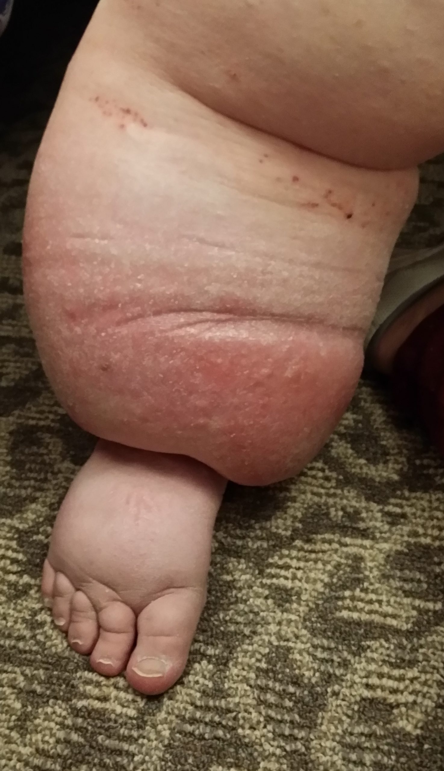The Difference between Lymphedema vs. Edema